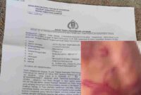 Laporan Polisi dan bekas lebam pada tubuh siswa
